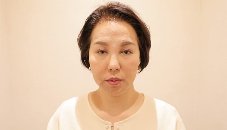 50代 女性 ムラタ マユミさん 生え際 自毛植毛 2,500株の症例 施術後