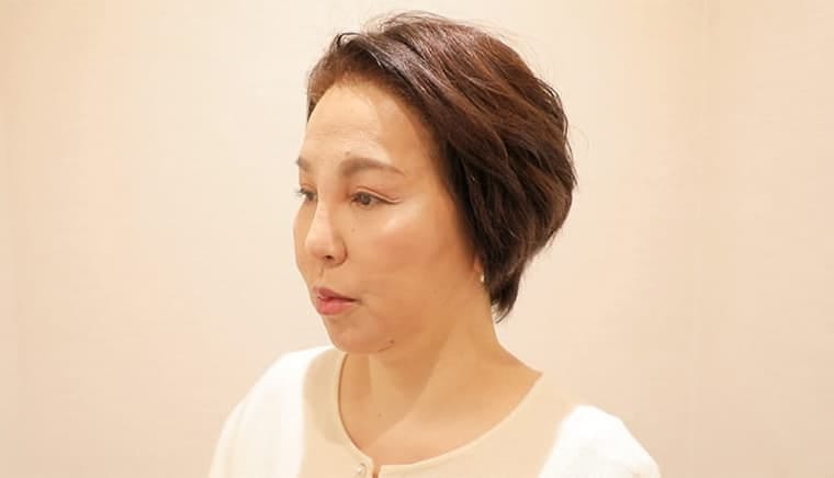 50代 ムラタ マユミさん 生え際 自毛植毛 2,500株の症例 施術後