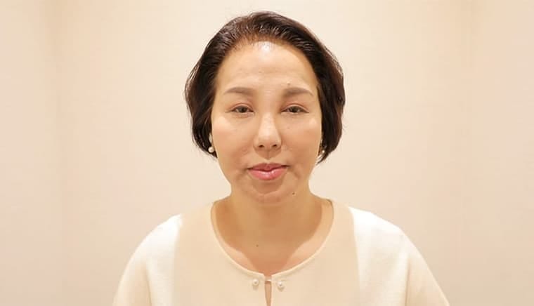 50代 ムラタ マユミさん 生え際 自毛植毛 2,500株の症例 施術後笑顔