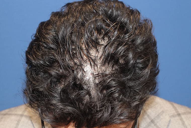 30代 男性 F.A.さん 前頭部・頭頂部 自毛植毛 1,300株の症例 施術後