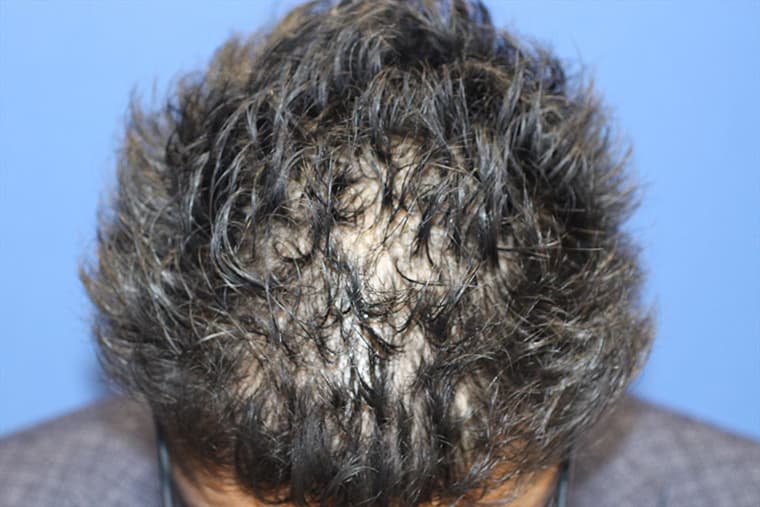 30代 男性 F.A.さん 前頭部・頭頂部 自毛植毛 1,300株の症例 施術前