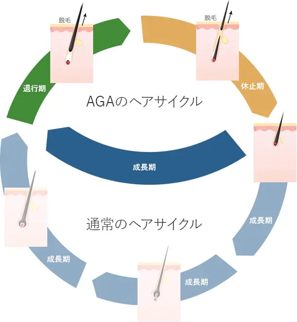 AGAのヘアサイクル 通常のヘアサイクル